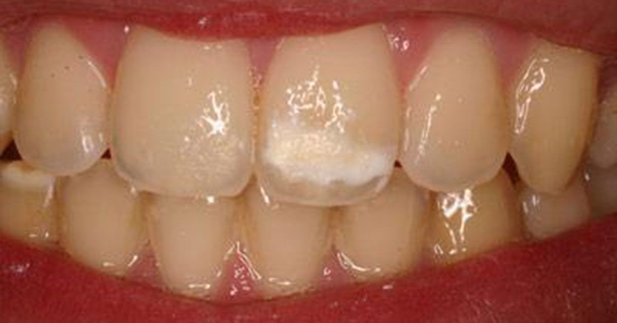 what-causes-chalky-teeth-aka-hypomineralisation-plainland-dental