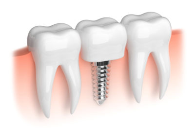 Dental Implants