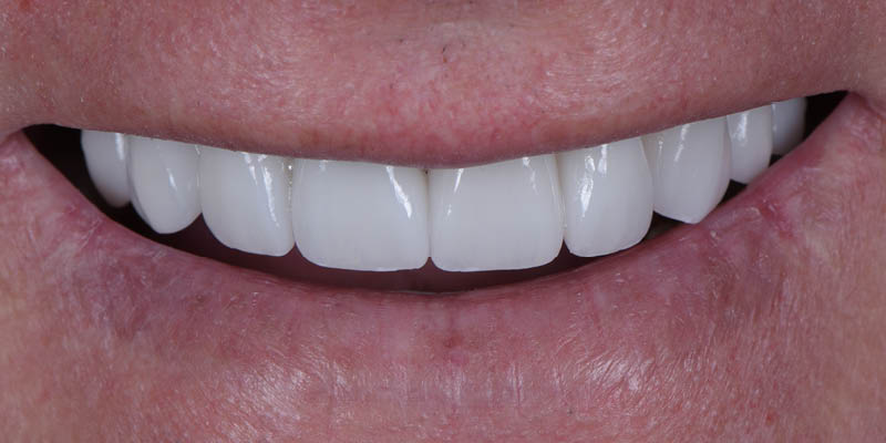 Veneers - After Teeth Photo