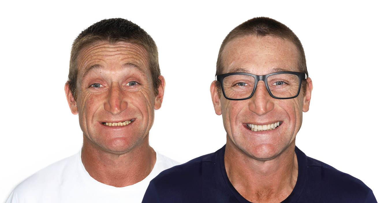All on Implants - Before and After Dental Headshot comparison.
