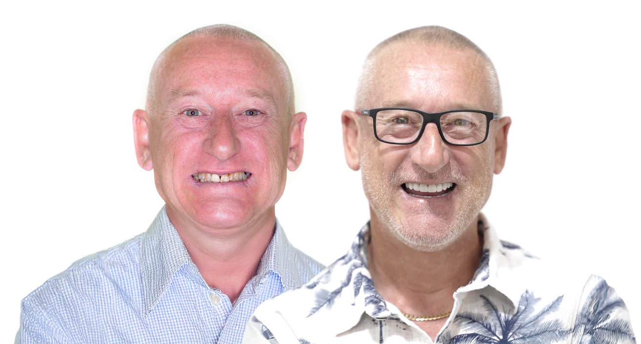 Veneers - Before and After Patient Headshots