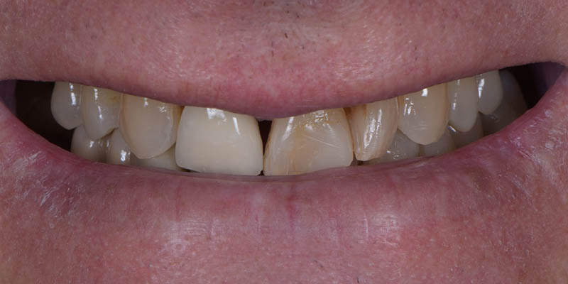 Veneers - Before Teeth Photo